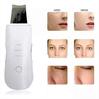 Espatula Peeling Pala Ultrasonica