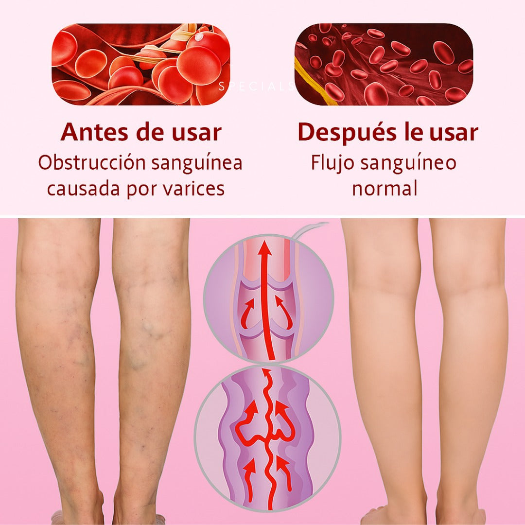 ¡Deshágase de las varices ahora! Compre 1 y llévese 2, ¡SÓLO HOY! HASTA AGOTAR EXISTENCIAS