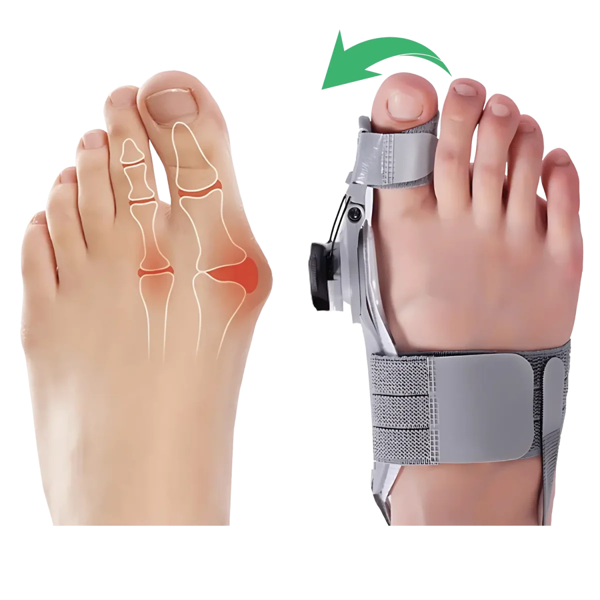 Feetifix™ Corrector Inteligente De Juanetes - HOY LA SEGUNDA UNIDAD POR SOLO + $54.000