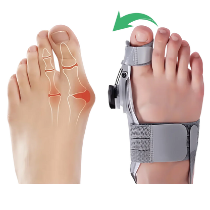 Feetifix™ Corrector Inteligente De Juanetes - HOY LA SEGUNDA UNIDAD POR SOLO + $54.000
