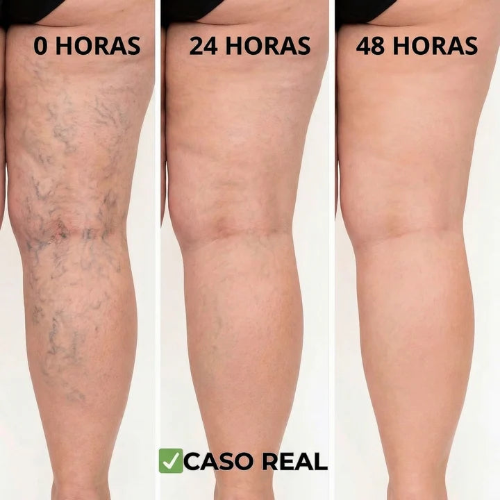 VeinPatch™ - Parches Naturales para Varices y Arañitas ( ¡12 UNIDADES! )