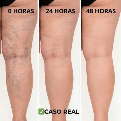 VeinPatch™ - Parches Naturales para Varices y Arañitas ( ¡12 UNIDADES! )