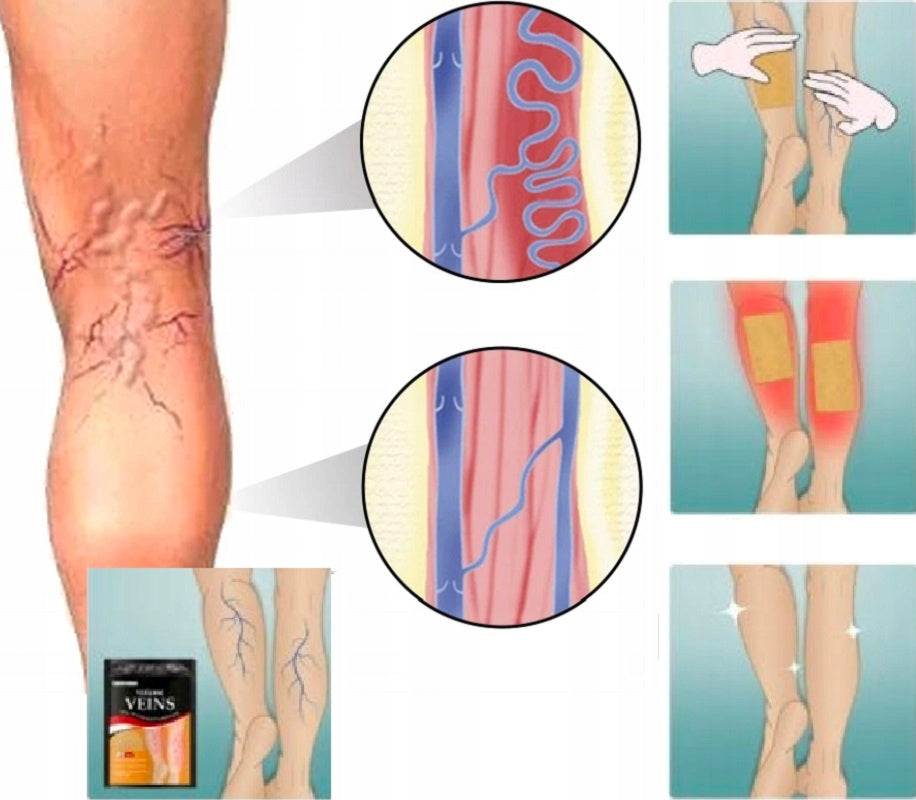 PAGUE 1 RECIBA 2 VARICOSE VEINS - SÓLO HOY